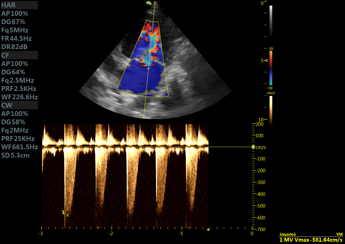 ecografia doppler